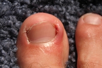 Common Reasons for Ingrown Toenails