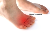 Surgery for Morton's Neuroma