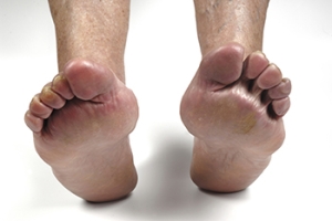 Lifestyle Choices and Their Effect on Rheumatoid Arthritis in the Feet