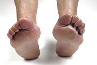 Lifestyle Choices and Their Effect on Rheumatoid Arthritis in the Feet