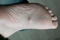 What Is a Plantar Fibroma?