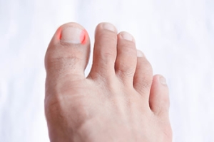 Managing an Ingrown Toenail