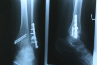 Ankle Fracture Surgery Facts